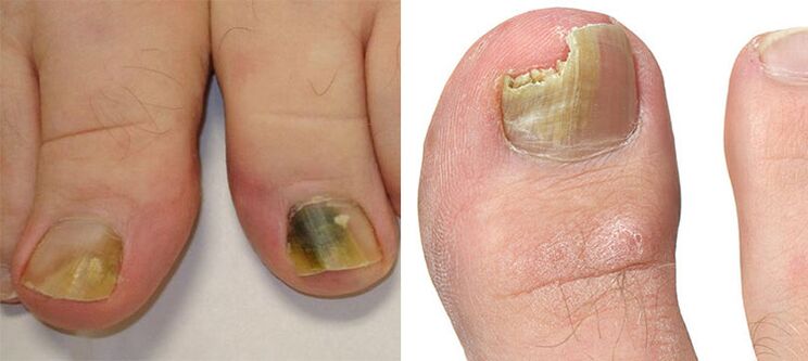 Onychomycosis - nagu iznīcināšana ar sēnīti